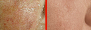 Dermatologo Napoli - Angiomi e rosacea