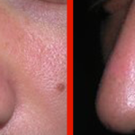 Dermatologo Napoli - Nevi dermici