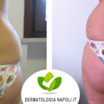 dermatologo-napoli-aversa-cavitazione