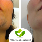 dermatologo-napoli-aversa-laseradioodi