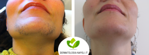 dermatologo-napoli-aversa-laseradioodi