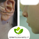 dermatologo-napoli-aversa-laseradioodi