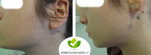 dermatologo-napoli-aversa-laseradioodi