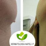 dermatologo-napoli-aversa-laseradioodi