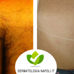 dermatologo-napoli-aversa-laseradioodi