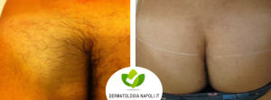 dermatologo-napoli-aversa-laseradioodi