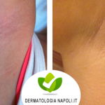 dermatologo-napoli-aversa-laseradiodi