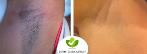 dermatologo-napoli-aversa-laseradiodi