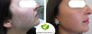 dermatologo-napoli-aversa-needling