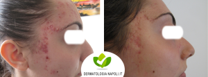 dermatologo-napoli-aversa-terapiafotodinamica