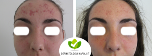 dermatologo-napoli-aversa-terapiafotodinamica