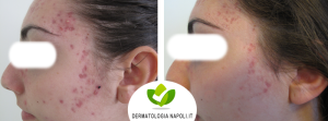 dermatologo-napoli-aversa-terapiafotodinamica