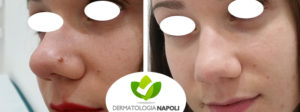 rimozione nevi dermici dermatologo napoli gaudiello