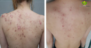 acne-10-dermatologia-napoli-francesca-gaudiello