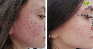 acne-12-dermatologia-napoli-francesca-gaudiello