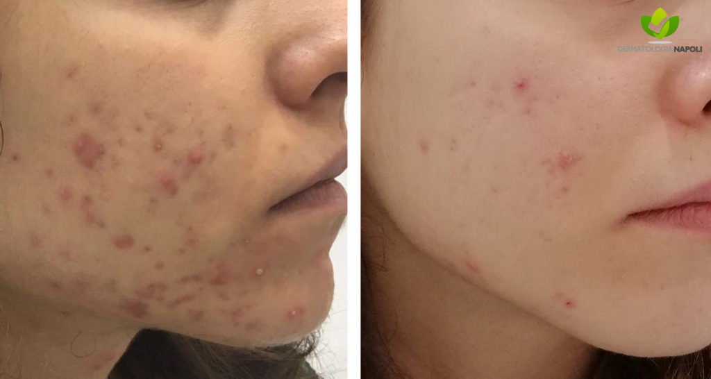 acne-13-dermatologia-napoli-francesca-gaudiello