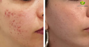 acne-14-dermatologia-napoli-francesca-gaudiello