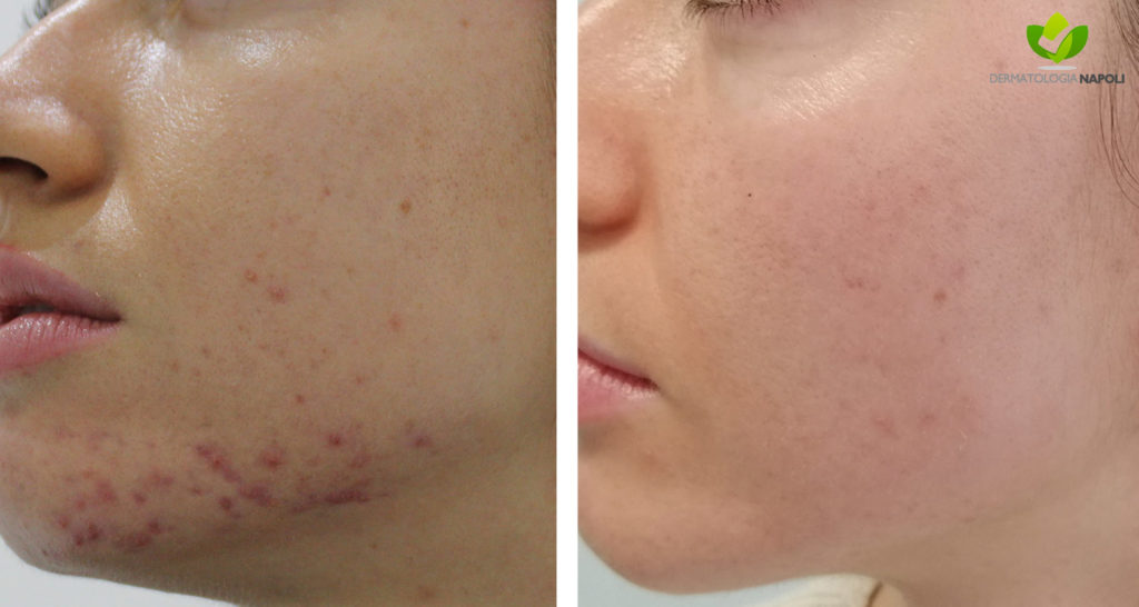 acne-15-dermatologia-napoli-francesca-gaudiello