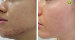 acne-15-dermatologia-napoli-francesca-gaudiello