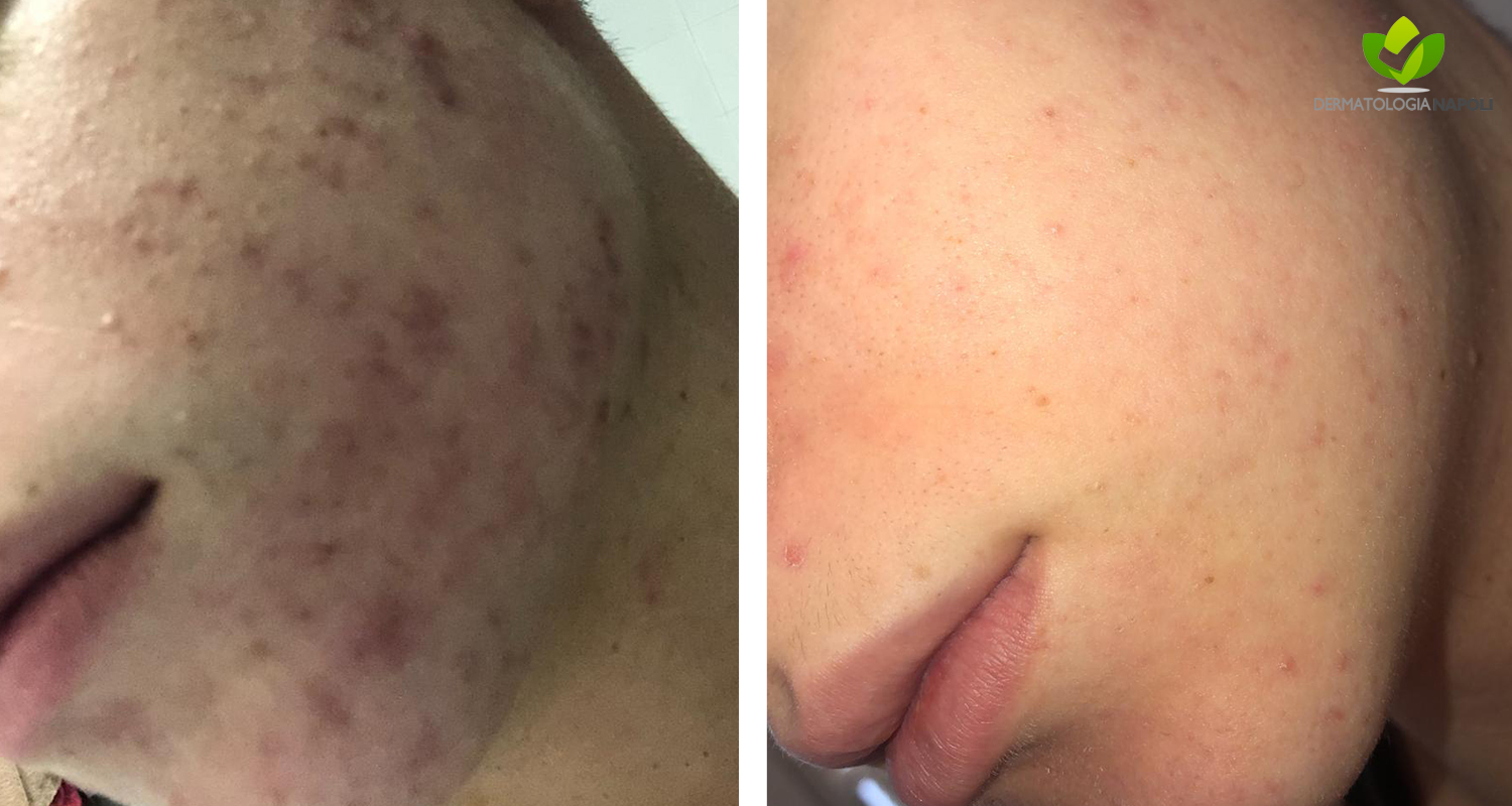 acne-16-dermatologia-napoli-francesca-gaudiello