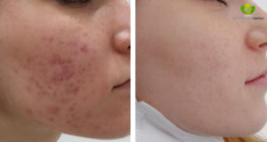 acne-17-dermatologia-napoli-francesca-gaudiello