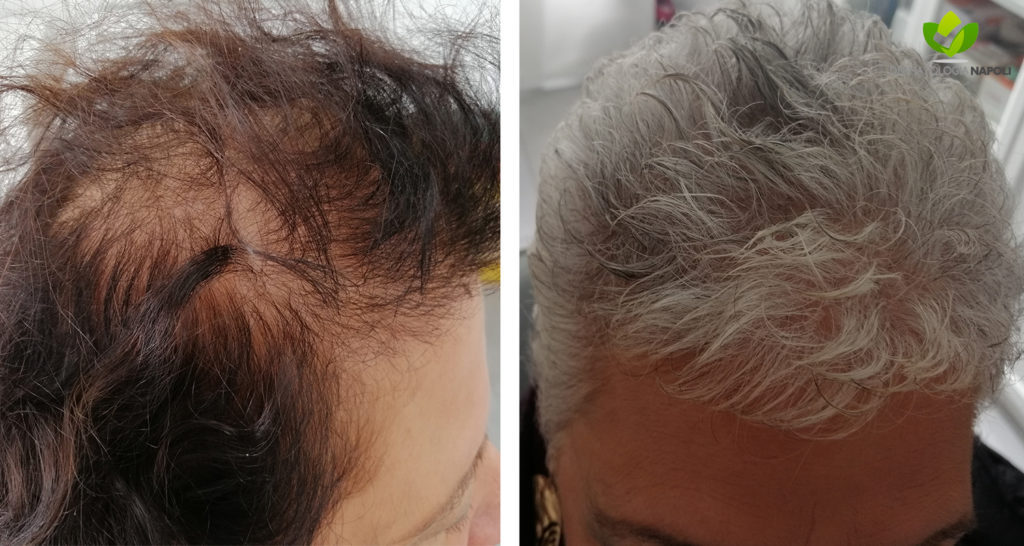 Lyn Kinematik Tilskynde Cura Alopecia Androgenetica | dott. Gaudiello dermatologa Napoli