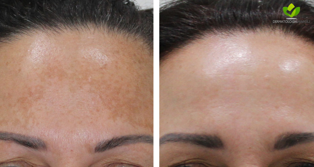 melasma-10-dermatologia-napoli-francesca-gaudiello