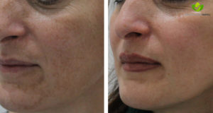 melasma-11-dermatologia-napoli-francesca-gaudiello