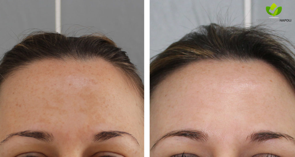 melasma-12-dermatologia-napoli-francesca-gaudiello