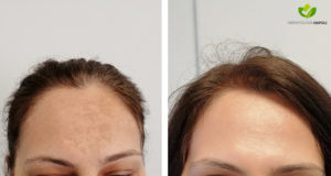 melasma-13-dermatologia-napoli-francesca-gaudiello