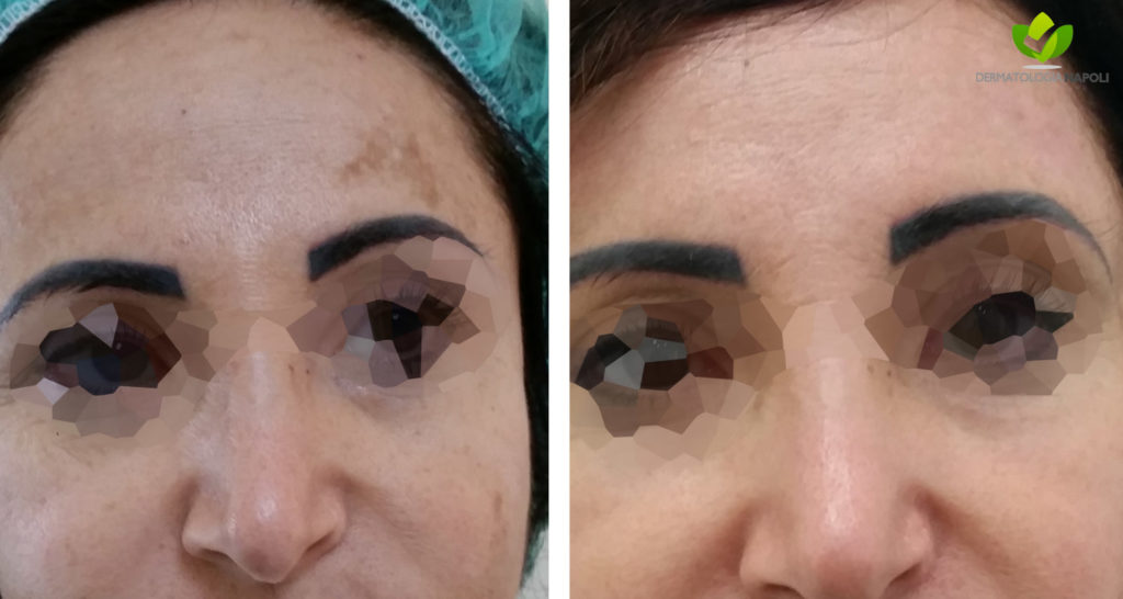 melasma-14-dermatologia-napoli-francesca-gaudiello